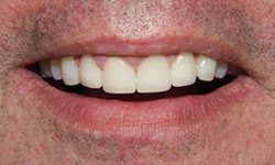 Closeup of teeth after crowns are placed