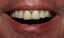 Closeup of teeth before treatment