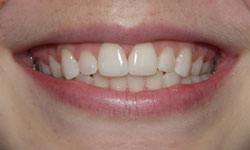 Closeup of aligned smile with bonding material