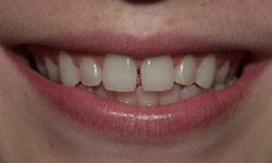 Closeup of teeth with gaps