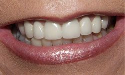 Closeup of flawless smile with resin bonding and porcelain crowns