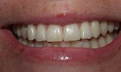 Yellow teeth before whitening