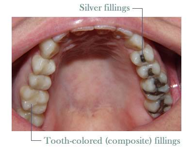 Inside of smile half with tooth-colored fillings half with silver fillings