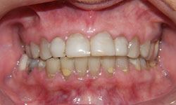Closeup of decayed and discolored teeth