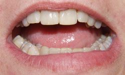 Closeup of reshaped teeth after treatment