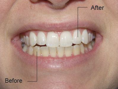 Closeup of discolored smile before teeth whitening and bright white smile after