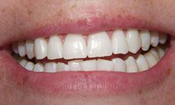 Brilliant smile after teeth whitening