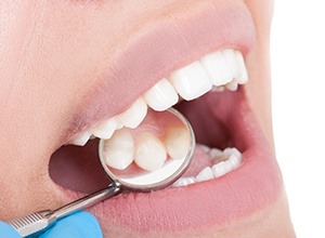 Closeup of patient's smile during dental exam