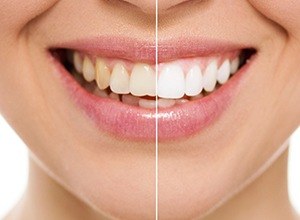 Smile half before and half after teeth whitening