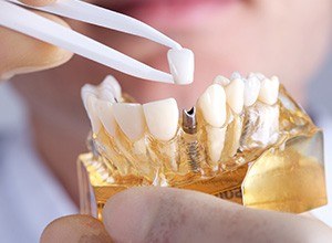 Model of implant supported dental crown