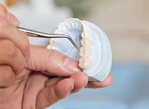 Model of smile with dental bridge