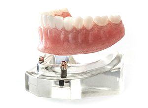 Model of implant denture