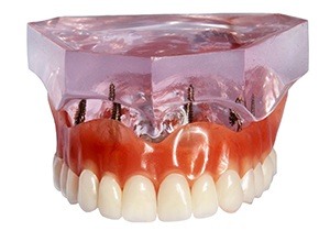 Model of All-on-4 dentures