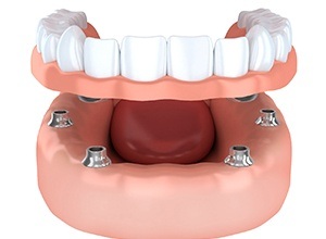 implant-retained dentures