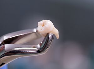 Metal clasp holding extracted tooth