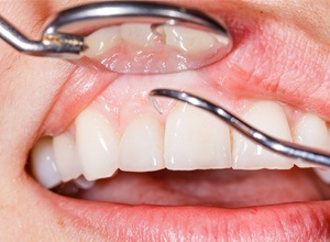 Traditional gum treatments