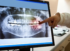 Panoramic dental x-rays on computer