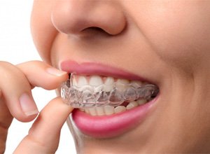 A person removing their whitening tray.